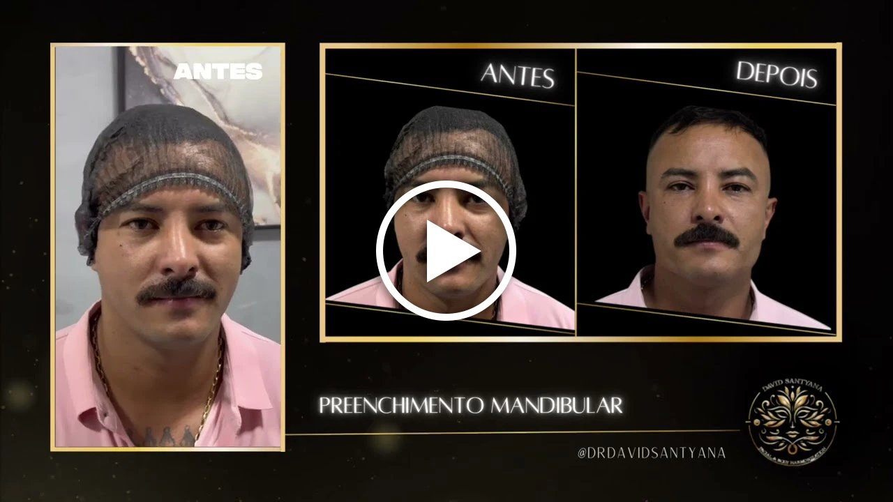 Vídeo Mandibular