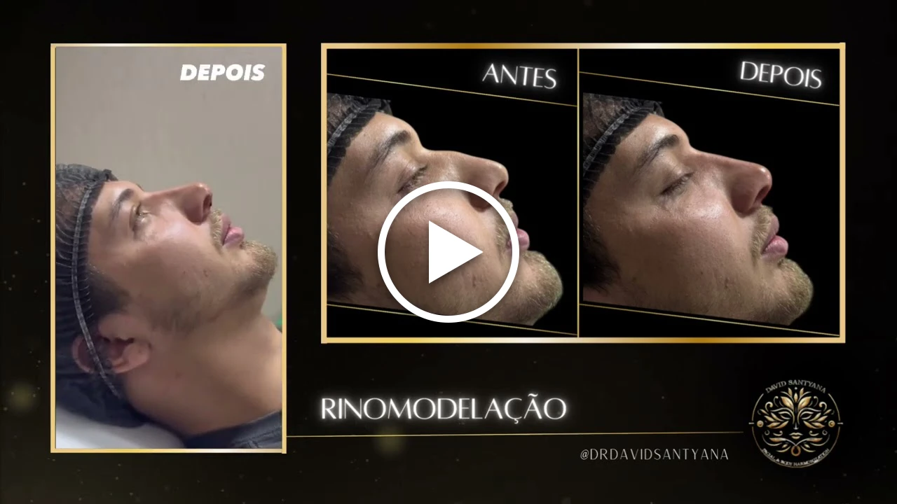 Vídeo Rinomodelação