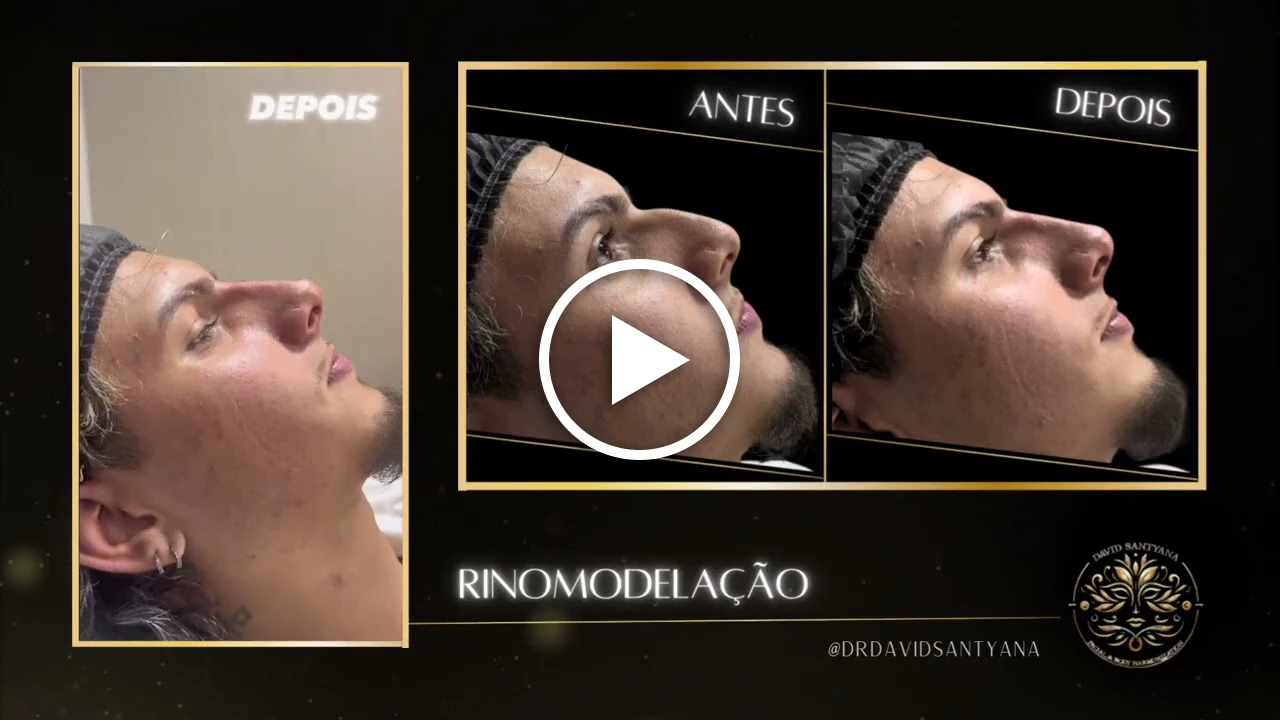 Vídeo Rinomodelação