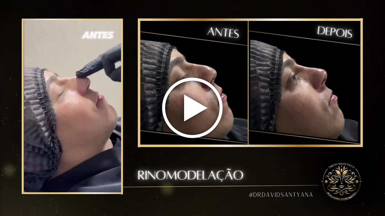 Vídeo Rinomodelação