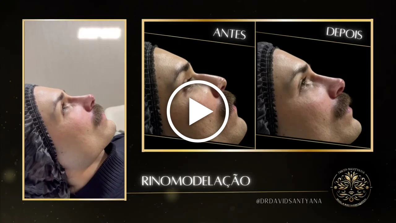 Vídeo Rinomodelação