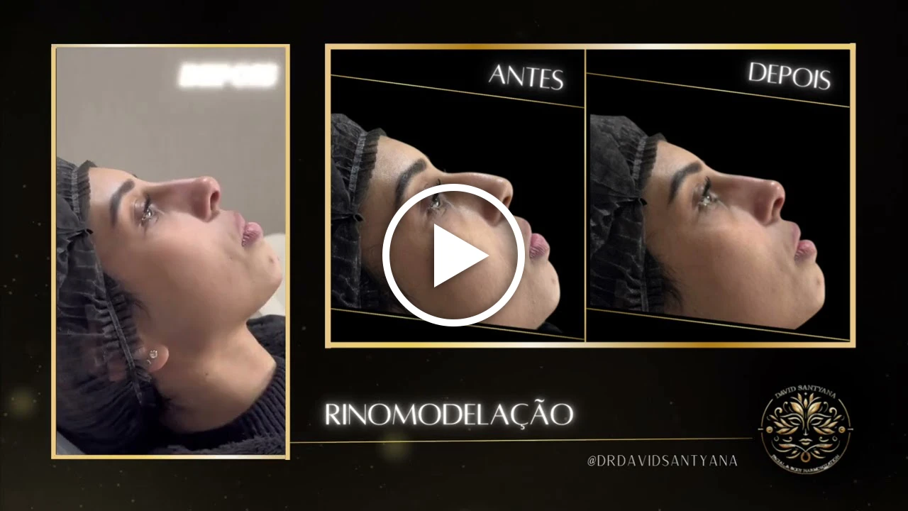 Vídeo Rinomodelação