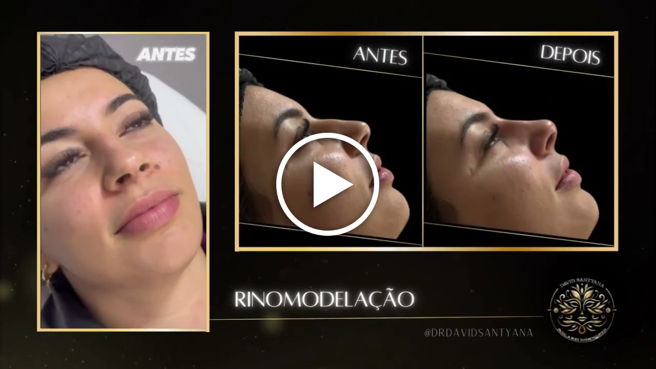 Vídeo Rinomodelação