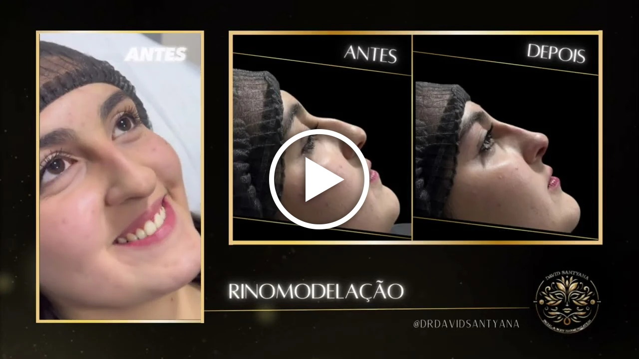 Vídeo Rinomodelação
