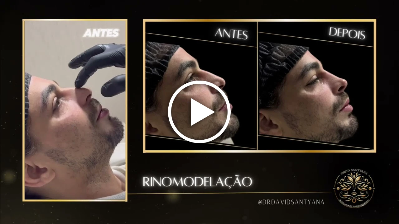 Vídeo Rinomodelação