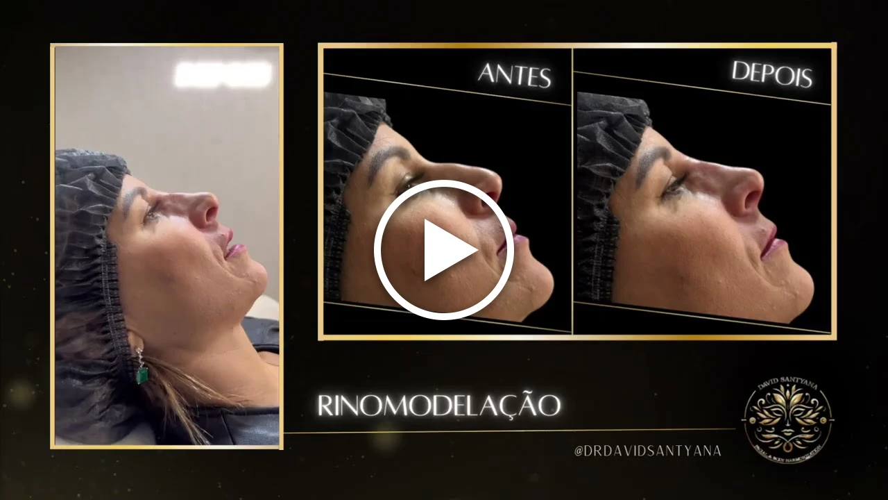 Vídeo Rinomodelação