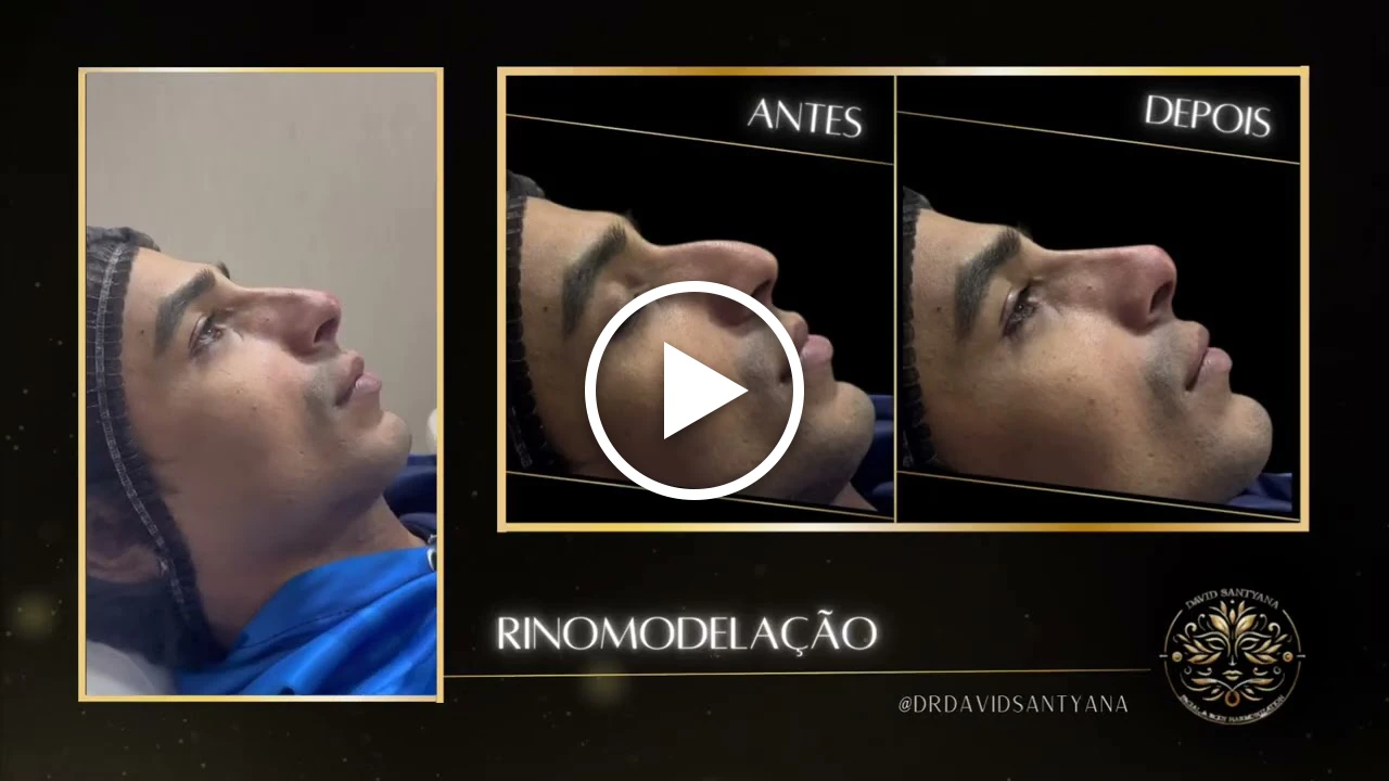 Vídeo Rinomodelação