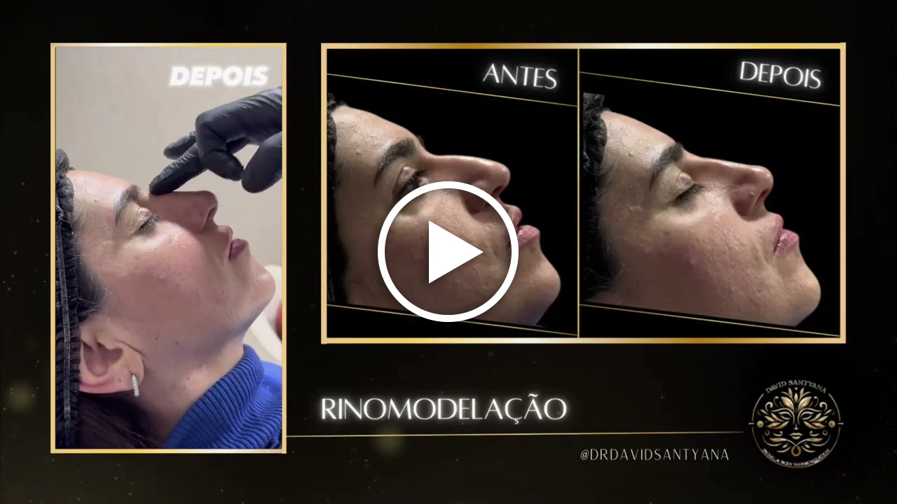 Vídeo Rinomodelação