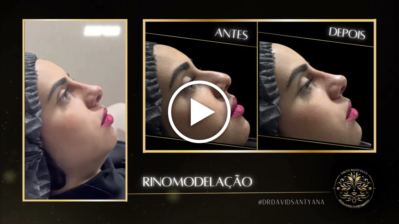 Vídeo Rinomodelação