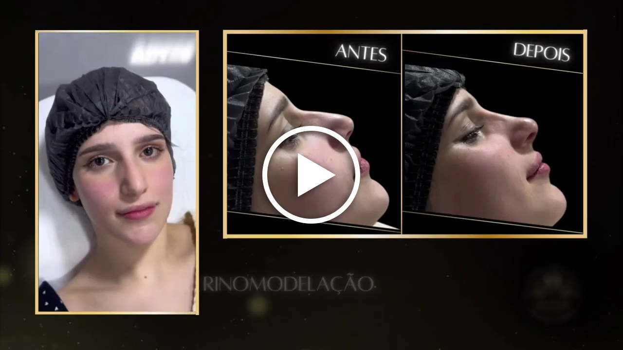 Vídeo Rinomodelação